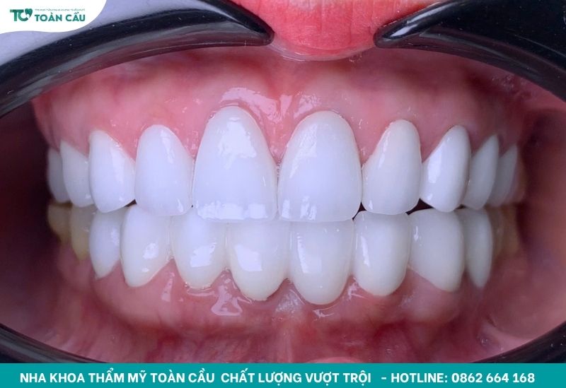 Làm răng sứ bị sai khớp cắn có sửa được không? 5 Làm răng sứ chuẩn khớp cắn