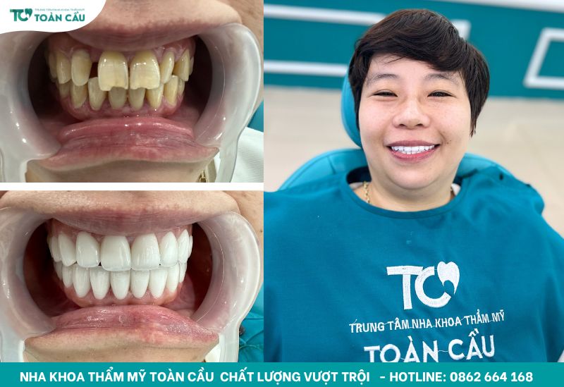 Làm răng sứ bị sai khớp cắn có sửa được không? 7 Khách hàng bọc sứ tại Nha khoa Toàn Cầu
