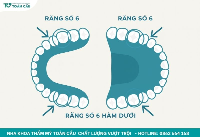 Bị mất răng số 6 hàm dưới có niềng răng được không? 2 Răng số 6 hàm dưới