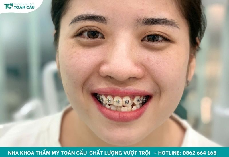 Bị mất răng số 6 hàm dưới có niềng răng được không? 3 Mất răng số 6 hàm dưới có thể niềng răng