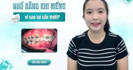 nhổ răng khi niềng