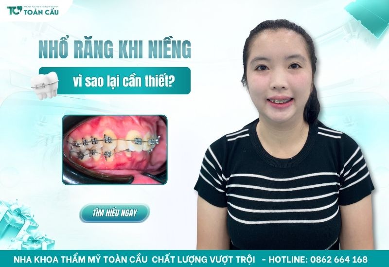 nhổ răng khi niềng