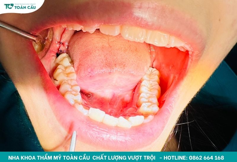 Lý do tại sao phải nhổ răng khi niềng có thể bạn chưa biết 4 Nhổ răng khôn