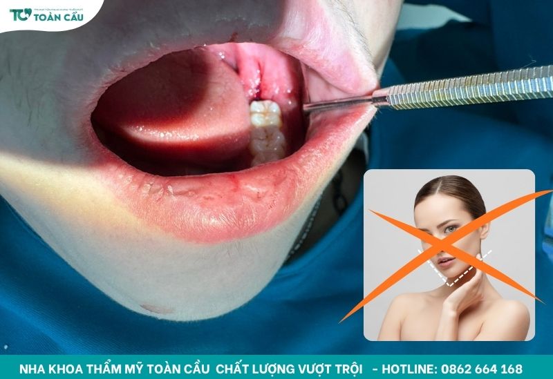 Nhổ răng khôn không làm thay đổi dáng mặt