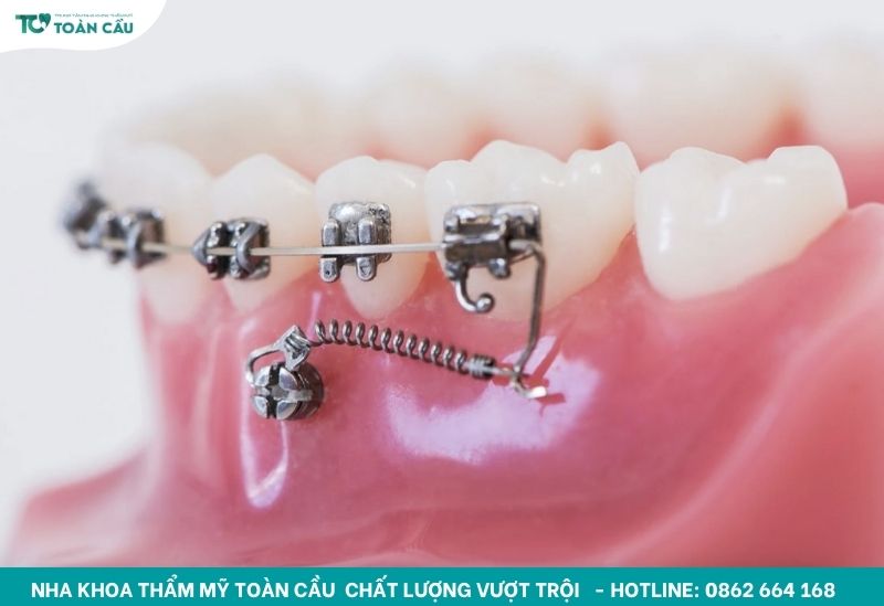 Niềng răng không cắm vis được không? Toàn Cầu giải đáp 2 Vis niềng răng