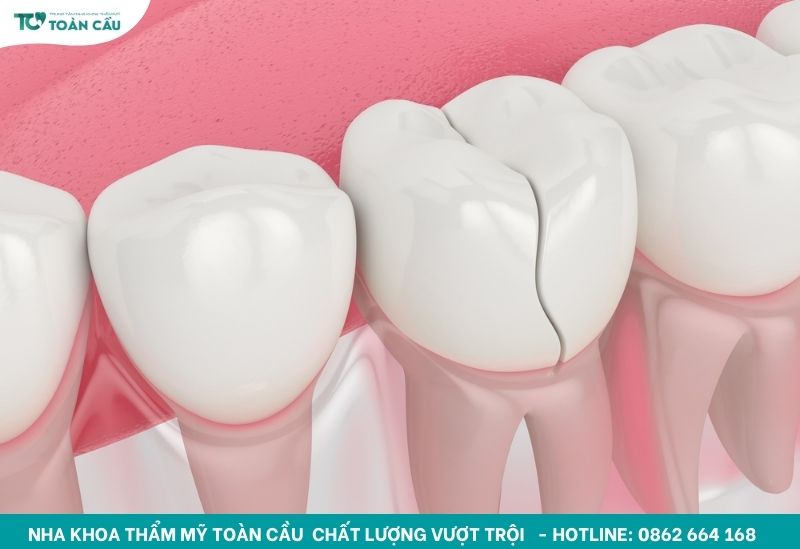 Răng bị nứt phải làm sao? 4 phương pháp khắc phục phổ biến 2 Răng bị nứt