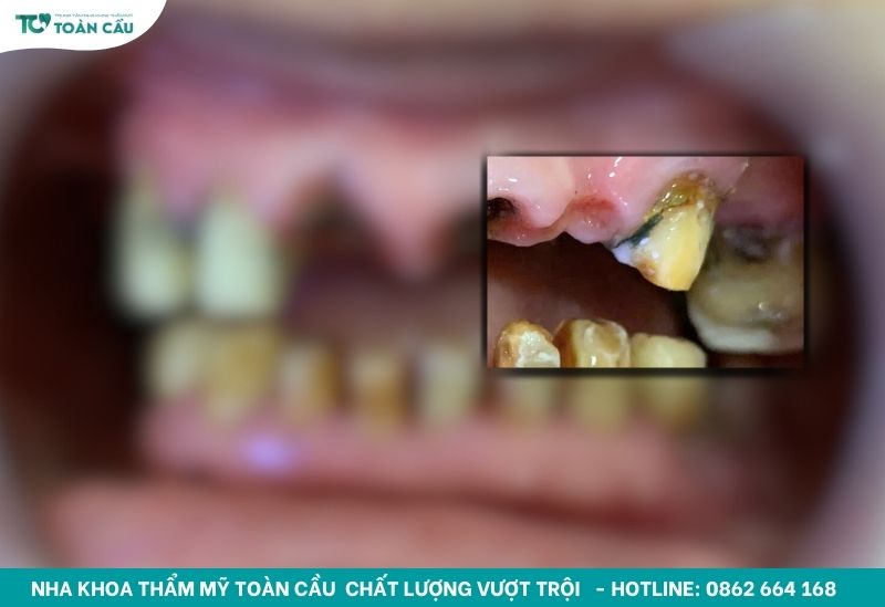 Răng lung lay có giữ được không? Khi nào cần phải nhổ bỏ? 2 Răng lung lay xuất phát từ nhiều nguyên nhân