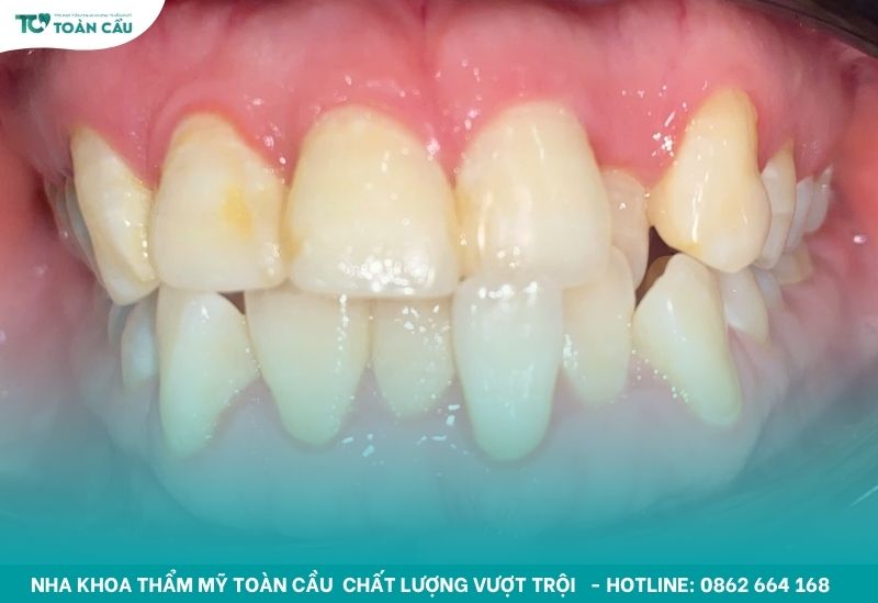 Răng lung lay có giữ được không? Khi nào cần phải nhổ bỏ? 4 Răng lung lay làm thay đổi khớp cắn