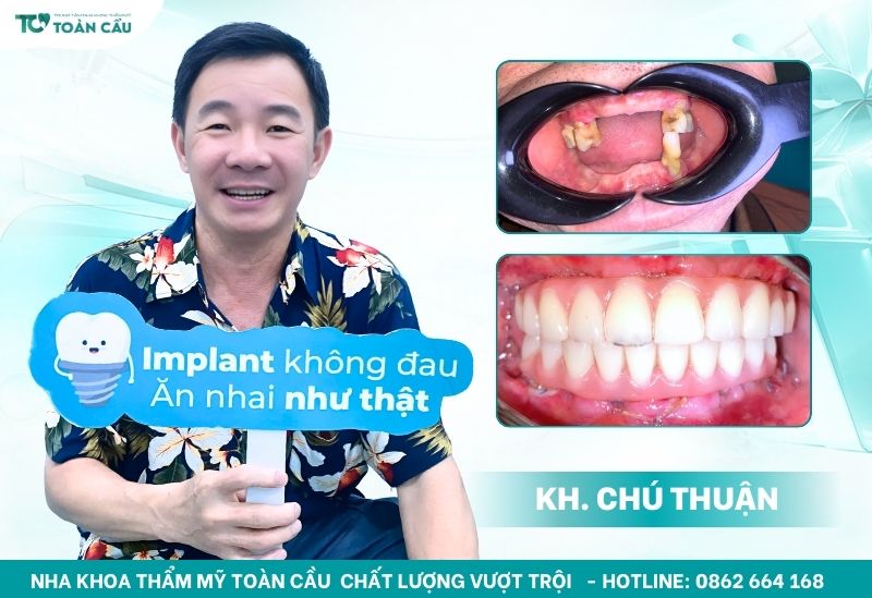 Danh sách thức ăn nên tránh sau cắm implant để răng nhanh lành 5 Khách hàng cắm implant tại Toàn Cầu