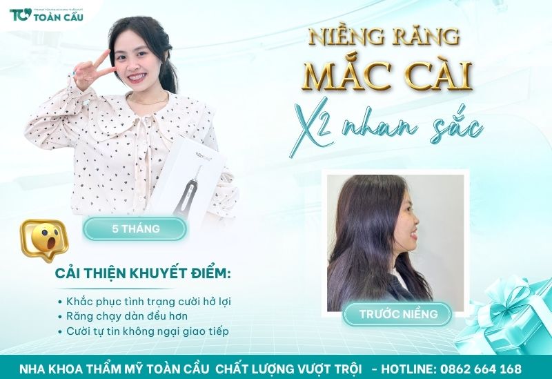 Gợi ý thực đơn 7 ngày cho người niềng răng dễ nhai, đủ chất 2 Niềng răng mắc cài