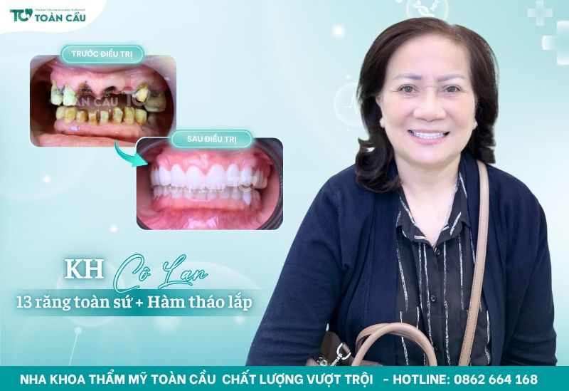 Những thực phẩm mới bọc sứ nên kiêng bạn nên biết 8 Bọc sứ đẹp tại Nha khoa Toàn Cầu