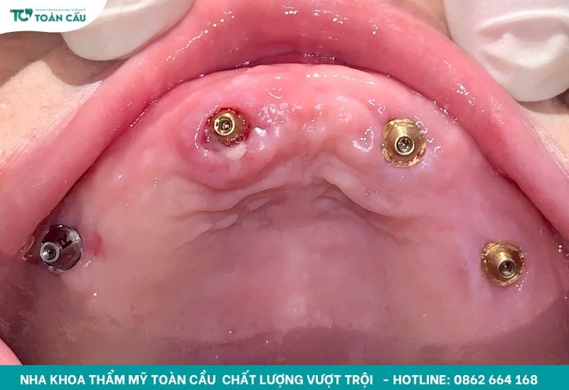 Sau khi trồng implant kiêng gì để vết thương mau lành? 3 Hàm vừa cấy Implant