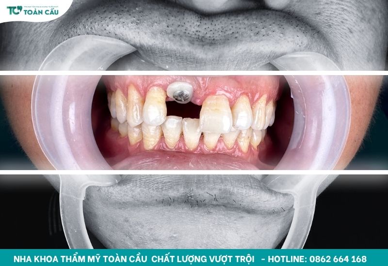 Trồng răng cửa bị gãy bao nhiêu tiền? Bảng giá làm răng 2025 2 Trồng răng cửa
