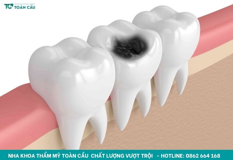 Trồng răng hàm bị sâu cần lưu ý gì? 2 Răng hàm bị sâu