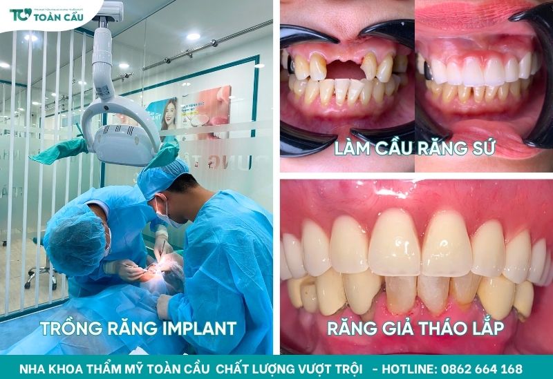 Trồng răng hàm bị sâu cần lưu ý gì? 3 Các phương pháp trồng răng hàm phổ biến