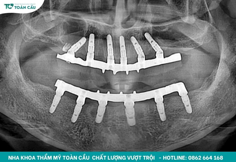 Trụ implant bị lung lay có phải tháo bỏ? 3 Trụ implant cắm với kỹ thuật đúng