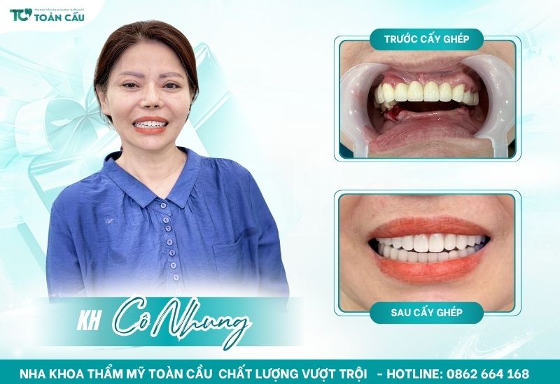 Trụ implant bị lung lay có phải tháo bỏ? 6 Trồng implant tại Nha khoa Thẩm mỹ Toàn Cầu