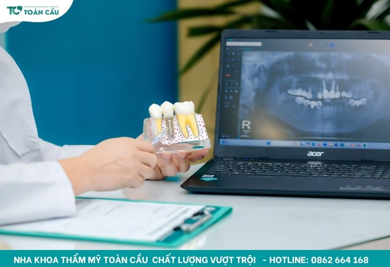 Tuổi thọ trồng răng implant trung bình là bao lâu? 2 Tuổi thọ răng Implant trung bình là bao lâu?
