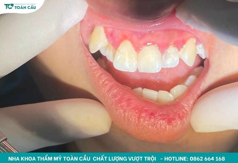 Giải đáp tụt lợi có tự khỏi không và cách điều trị hiệu quả 2 Cao răng là một trong những nguyên nhân gây tụt lợi