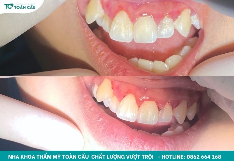 Giải đáp tụt lợi có tự khỏi không và cách điều trị hiệu quả 4 Cạo vôi làm sạch răng