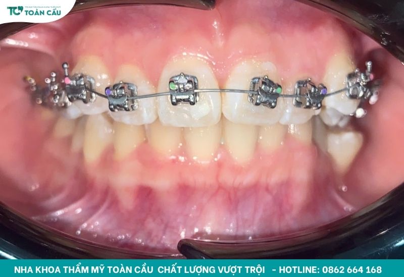 Vì sao nên vệ sinh răng niềng đúng cách?