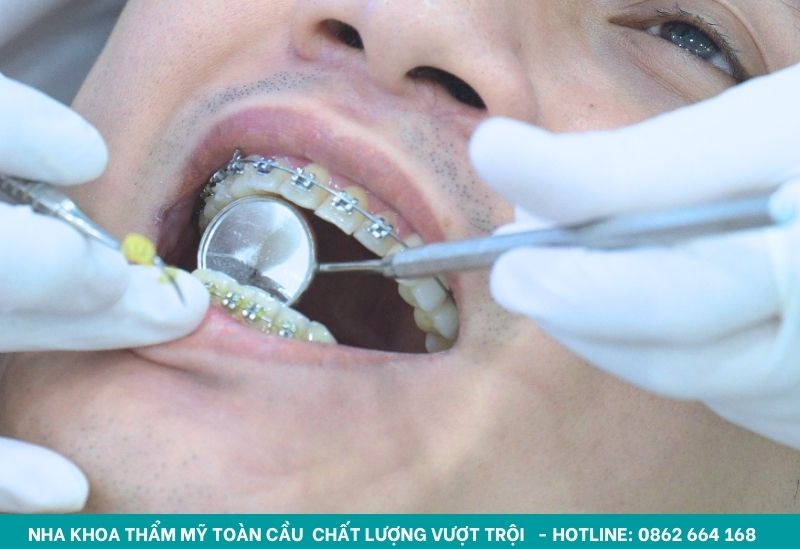 Kiểm tra mắc cài hằng ngày