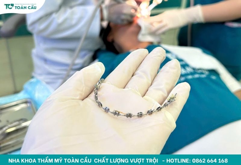 Dây cung niềng răng đạt chuẩn