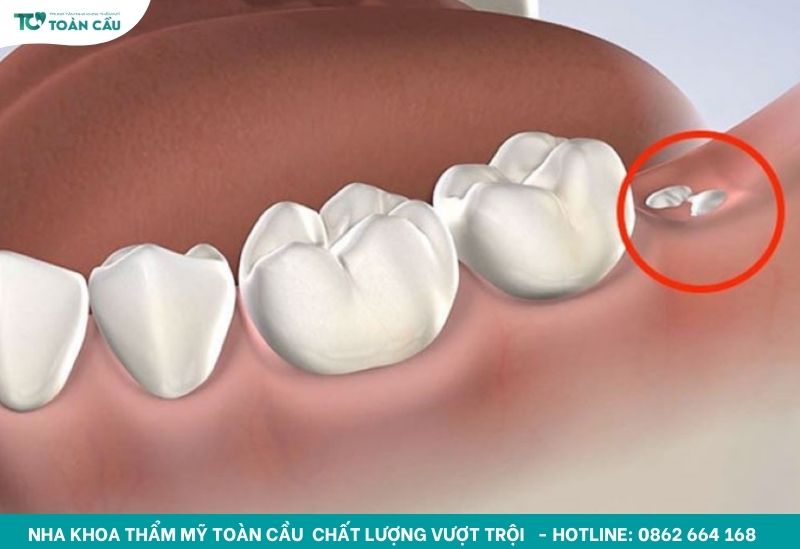 Bí quyết xử lý nhổ sót chân răng không lo viêm nhiễm 2 Nhổ sót chân răng là gì?