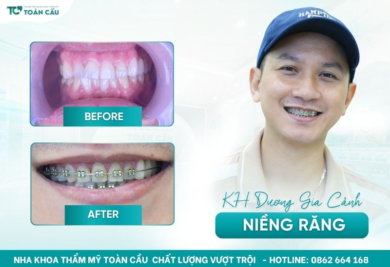 Anh Cảnh niềng răng ở độ tuổi U30