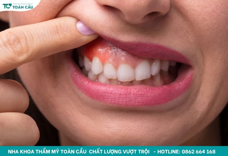 Bị nha chu là gì? Khám ở đâu uy tín để điều trị dứt điểm? 2 Bị nha chu là gì?