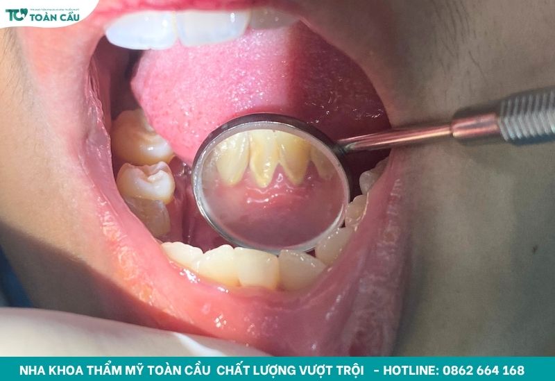 Bị nha chu là gì? Khám ở đâu uy tín để điều trị dứt điểm? 5 Lấy cao răng định kỳ