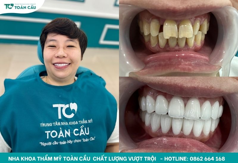 Khách hàng bọc răng sứ