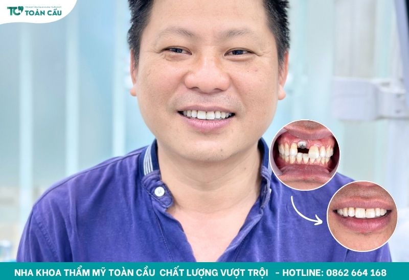 Khách hàng trồng răng implant tại Toàn Cầu