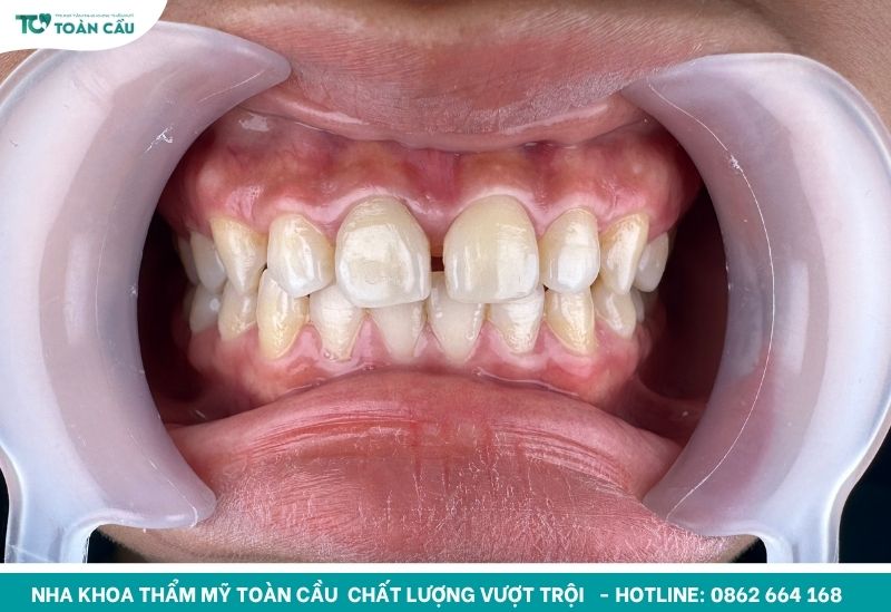 Nguyên nhân khiến răng bị thưa là gì?