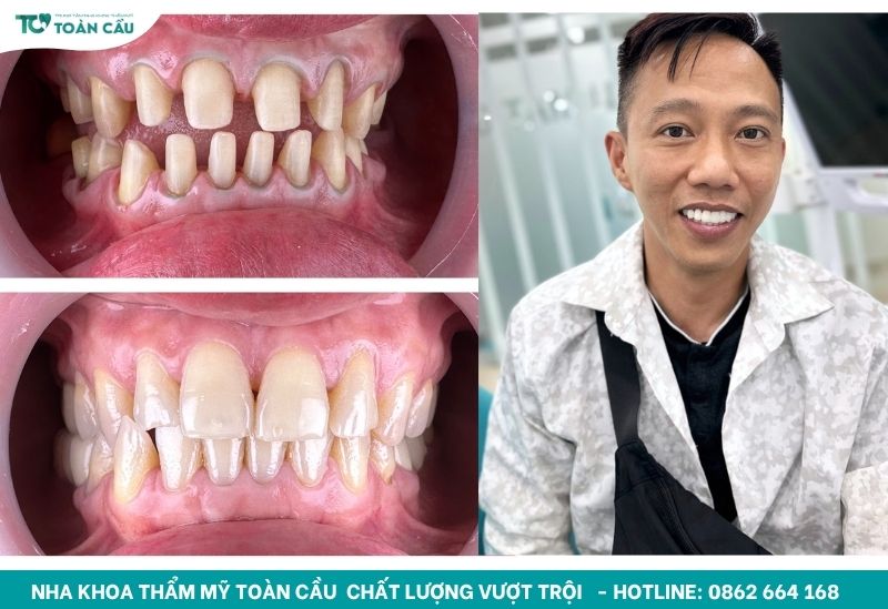 Khách hàng chọn bọc răng sứ
