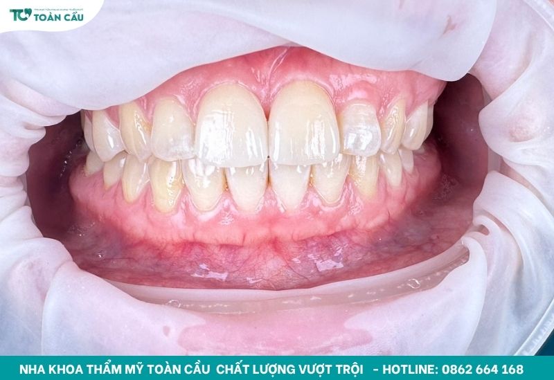 Khách hàng dán Veneer phục hồi răng thưa 
