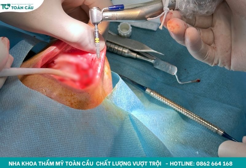 Giải đáp sau khi cấy implant có bị hôi miệng không 2 Nguyên nhân chính gây hôi miệng sau khi cấy Implant