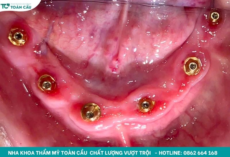 Giải đáp sau khi cấy implant có bị hôi miệng không 3 Trụ Implant