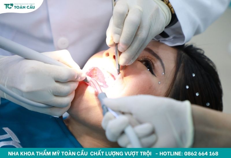 Tại sao lại chảy máu chân răng? Kéo dài có nguy hiểm không? 4 Lấy cao răng định kỳ tại nha khoa