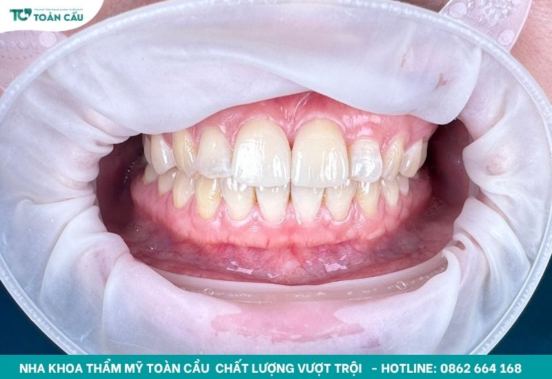 Dán sứ veneer 2 răng cửa tại Toàn Cầu