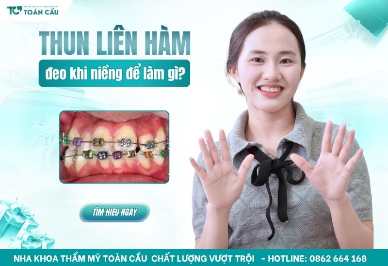 đeo thun liên hàm để làm gì