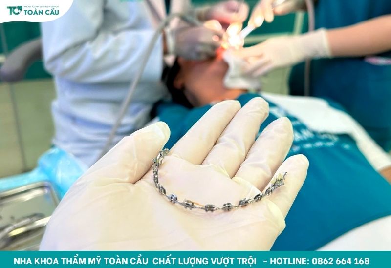 Thun liên hàm là bước cần thiết khi niềng răng