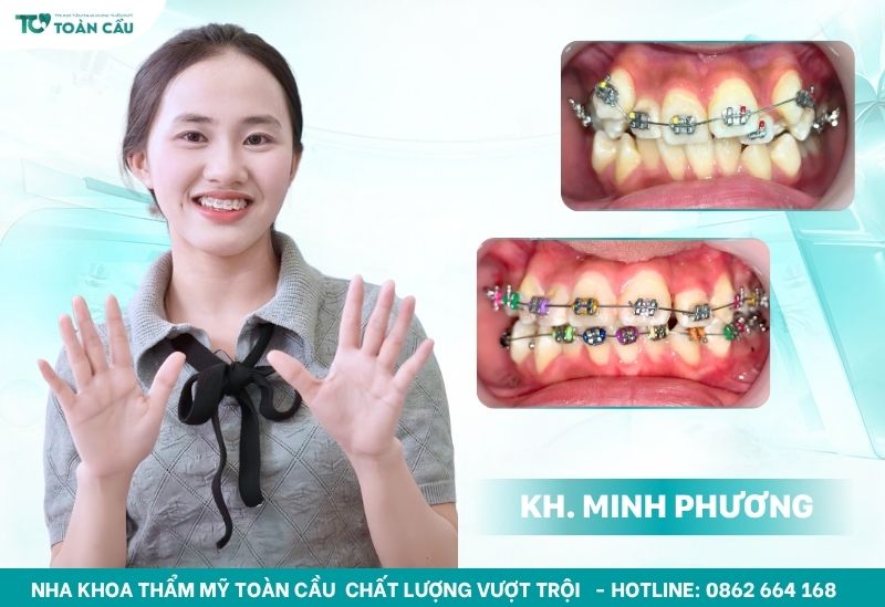 Khách hàng niềng răng tại Toàn Cầu