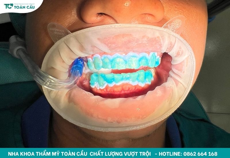 Dịch vụ tẩy trắng răng