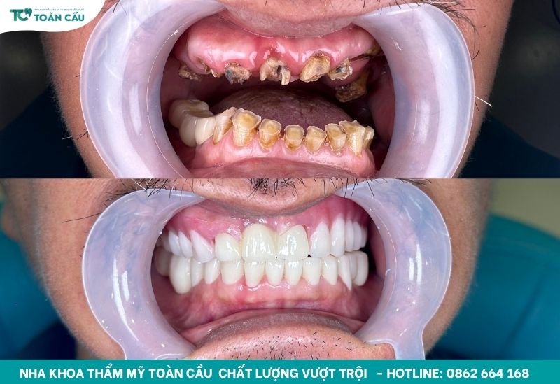 Hàm răng giả tháo lắp là một giải pháp tốt