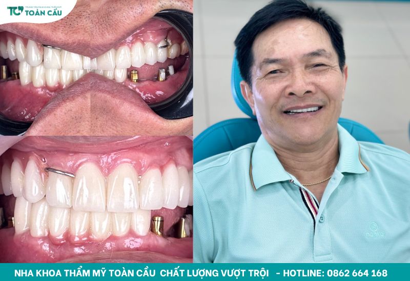 Hàm tháo lắp là một giải pháp hiện đại