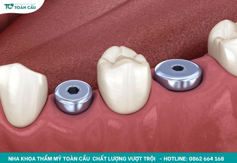 Healing implant còn gọi là healing abutment hoặc trụ lành thương