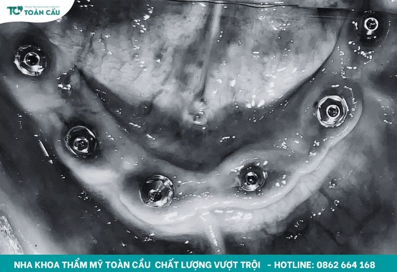 Healing implant che chắn lỗ ren kết nối trên trụ implant