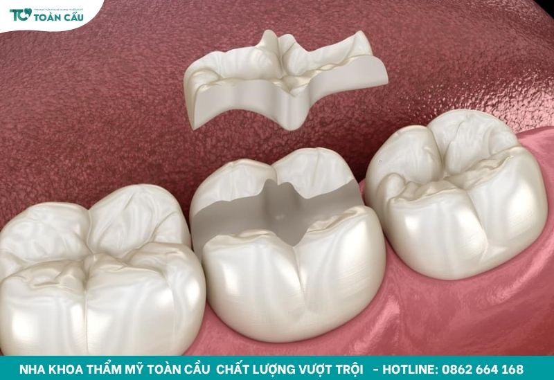 Inlay Onlay là gì?