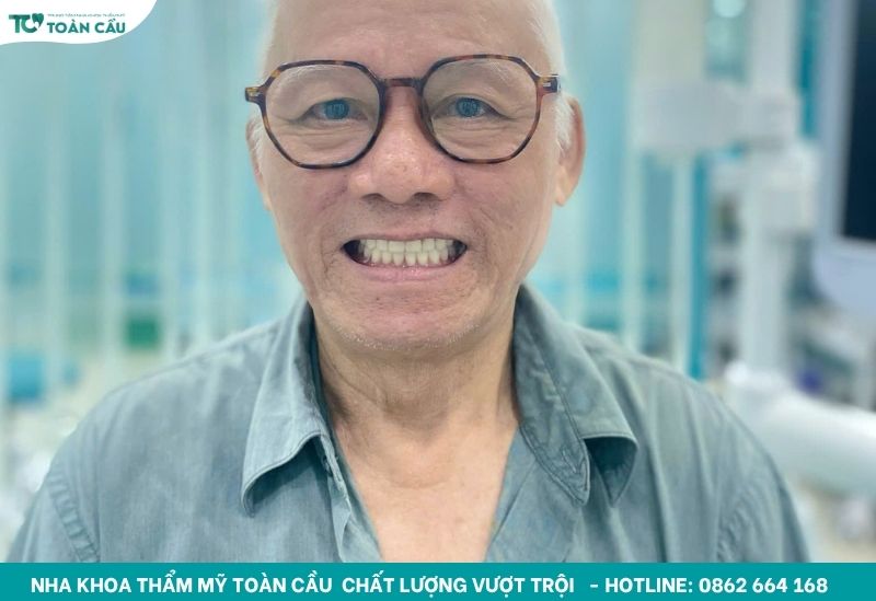 Mất răng lâu năm có trồng được không và chi phí bao nhiêu? 2 Mất răng lâu năm hoàn toàn có thể trồng lại